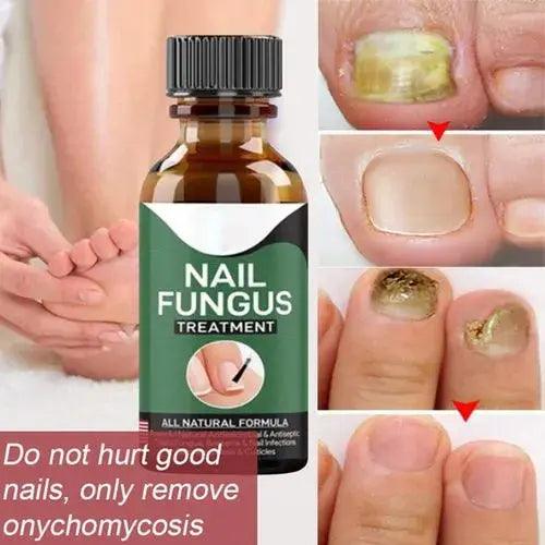 Nail Fungus Treatment Serum 10ml